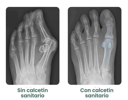 Calcetín Corrector de Juanetes FootEase™